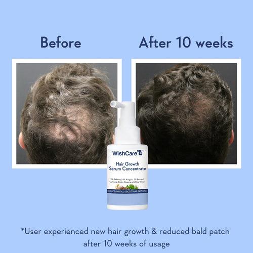 Hair Growth Serum Concentrate With 3% Redensyl, 4% Anagain, Rice Water, Biotin