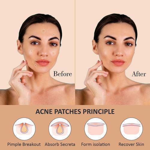 Rejusure Acne Patch | Waterproof Patches | Absorbs Pimple Overnight, Reduces Excess Oil | Acne Korean Spot Patch for Covering Zits and Blemishes | For All Skin Types | Men & Women (Pack of 2)